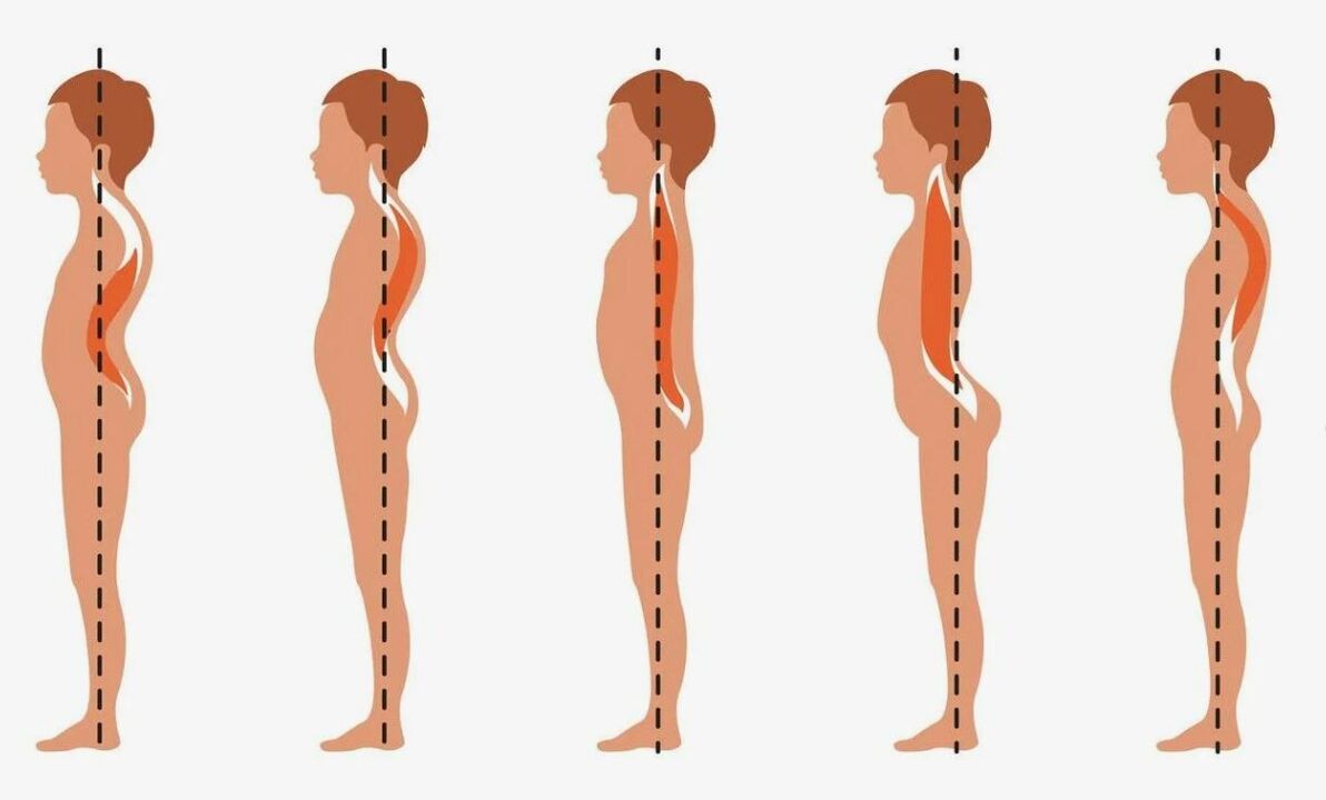 grado di sviluppo dell'osteocondrosi lombare