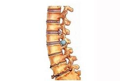 Fase di sviluppo dell'osteocondosi cervicale