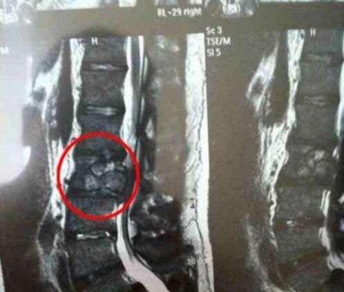 Il tumore della colonna vertebrale nella foto