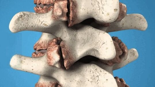 Osteofiti delle vertebre - Classioni patologiche che danneggiano i nervi e i vasi sanguigni