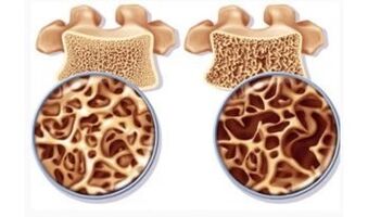 Pericolo di aspirazione cervicale per le donne
