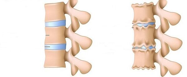Colonna vertebrale sana e osteocondosi