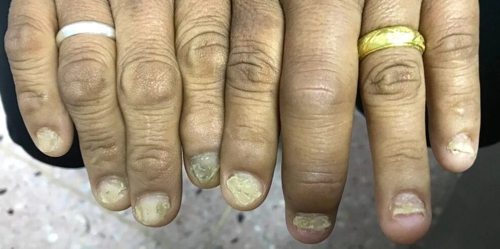 Il gonfiore delle dita e la deformazione della lamina ungueale possono indicare lo sviluppo dell'artrite psoriasica